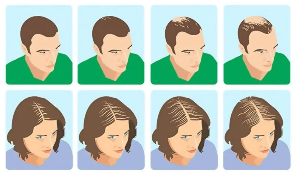 A diagram showing hair loss and hair thinning in men and women. Concept of hair loss, hair building fibers usage, hair thinning.